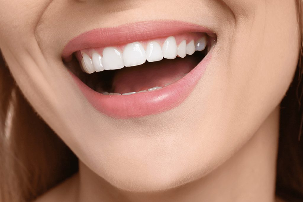 Hollywood Smile in Turchia