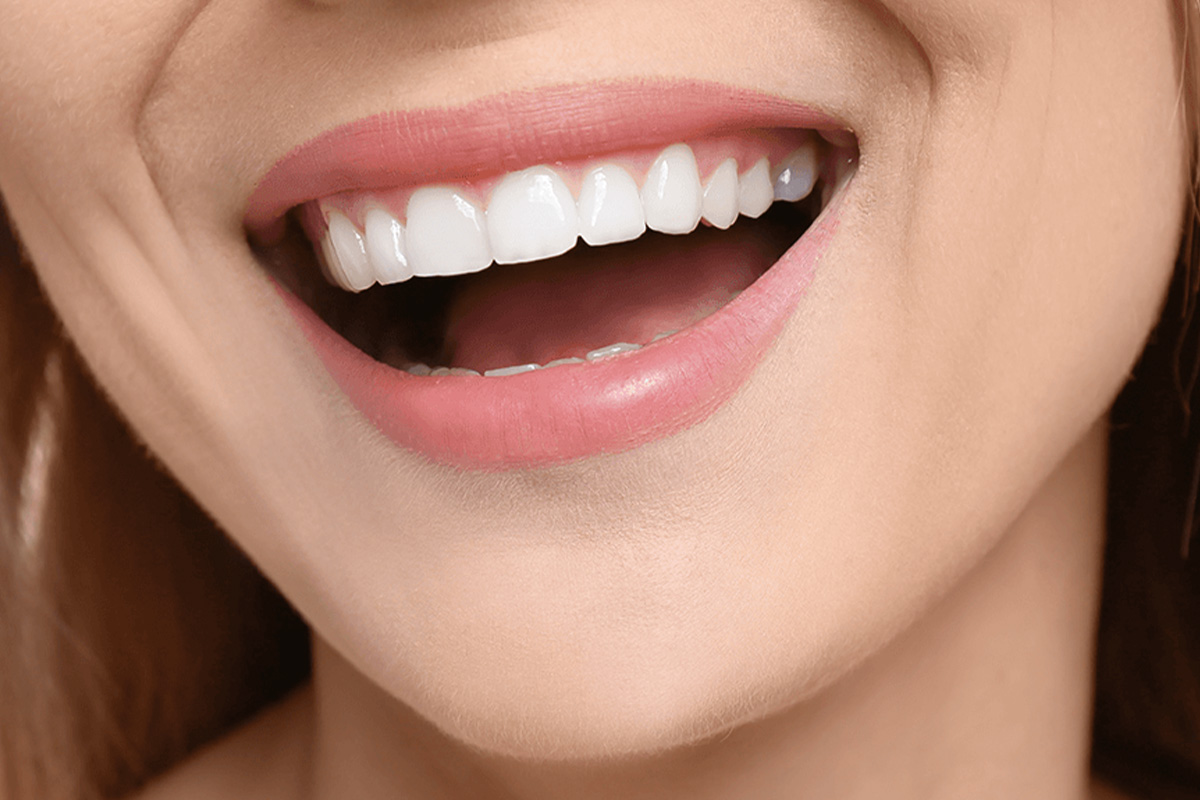 Hollywood Smile in Turchia