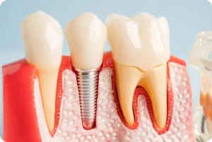 Dental Implant Turkey